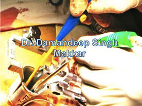 Dr. Damandeep Singh Makkar performing advanced micro-spine surgery to treat slip disc and spinal stenosis