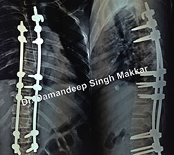 medical and critical care facilities at spine hospital Ludhiana