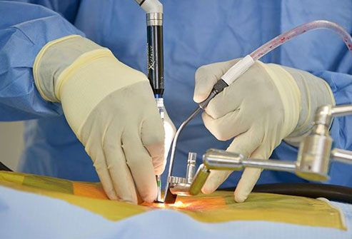 minimally invasive spine surgery procedure by spine specialist in Ludhiana