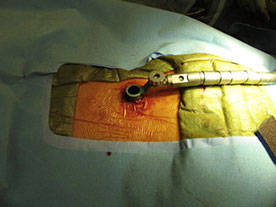 Close-up of a minimally invasive spine surgery using a tubular retractor system by Dr. Damandeep Singh Makkar in Ludhiana