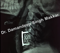 spine rehabilitation and physiotherapy treatment in Ludhiana