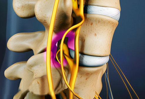 spinal stenosis treatment and spine care in Ludhiana